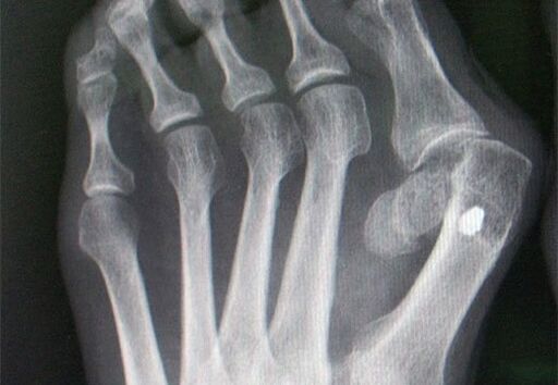 X -RAY