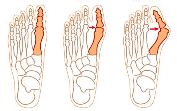 Hallux valgus deformatsioon