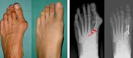 hallux valgus sümptomid