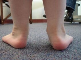 Lame valgus jala deformatsioon lapsel
