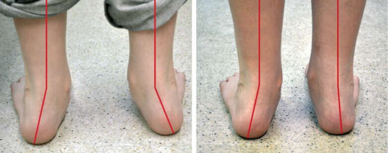 Valgus jalad