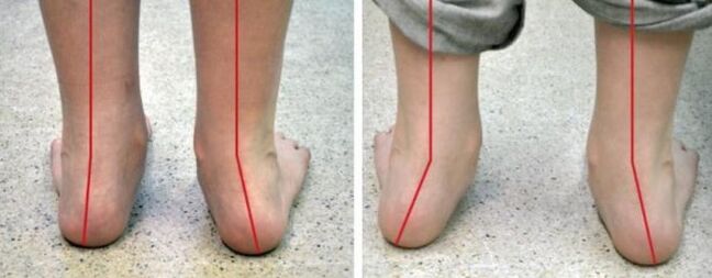Valgus jalg