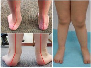 Valgus